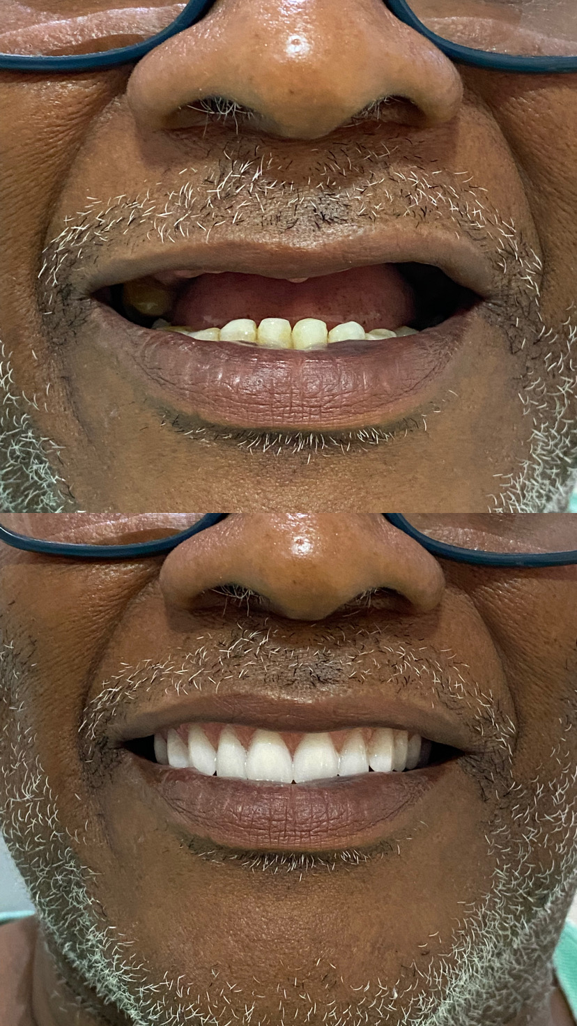Antes e depois — Lentes de contato dental