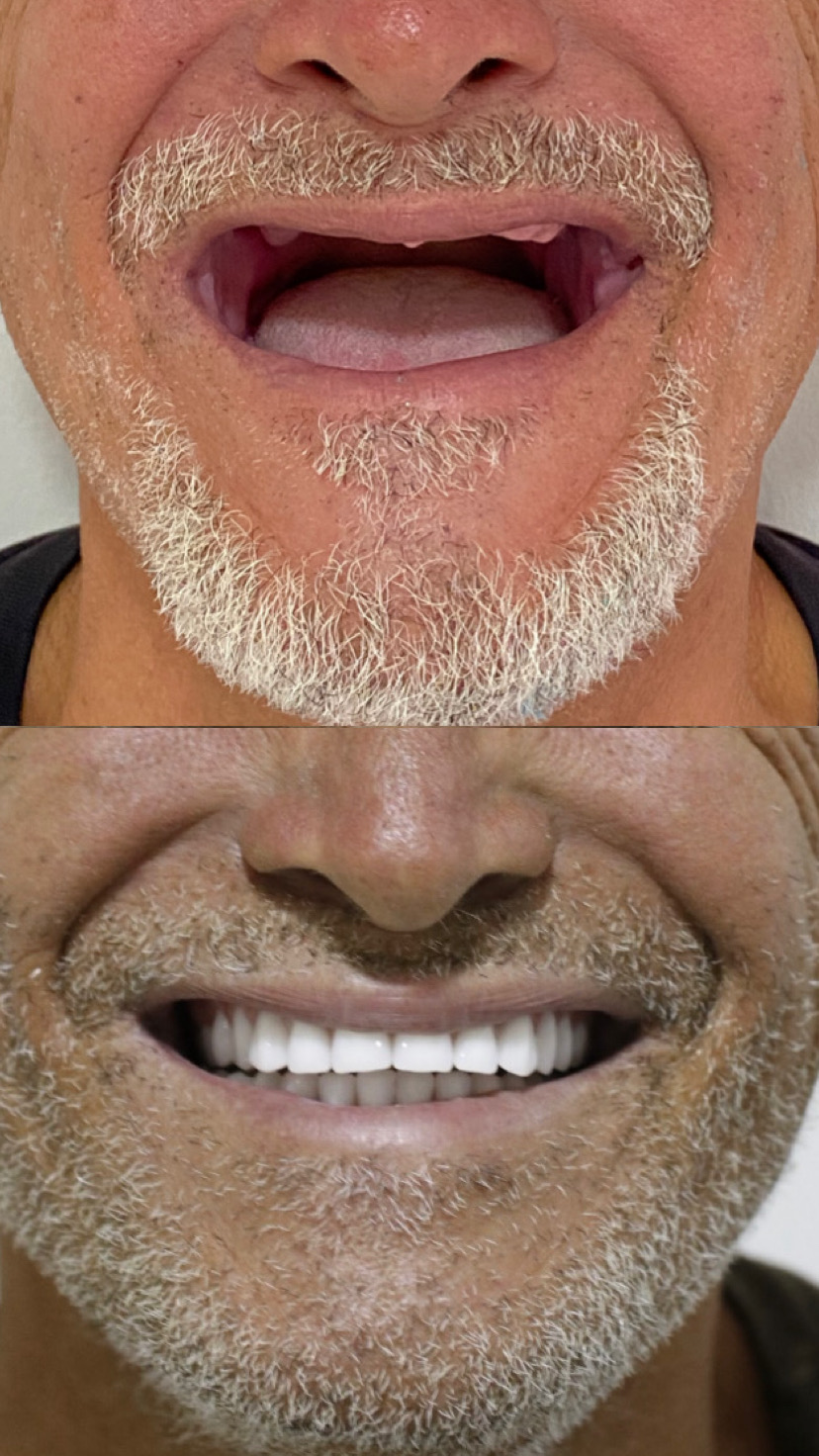 Antes e depois — Reabilitação total