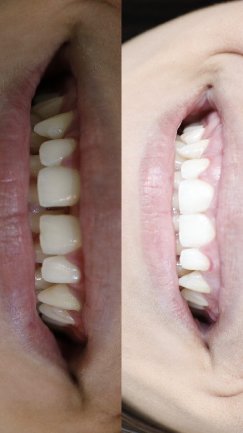 Antes e depois — Alinhadores invisíveis