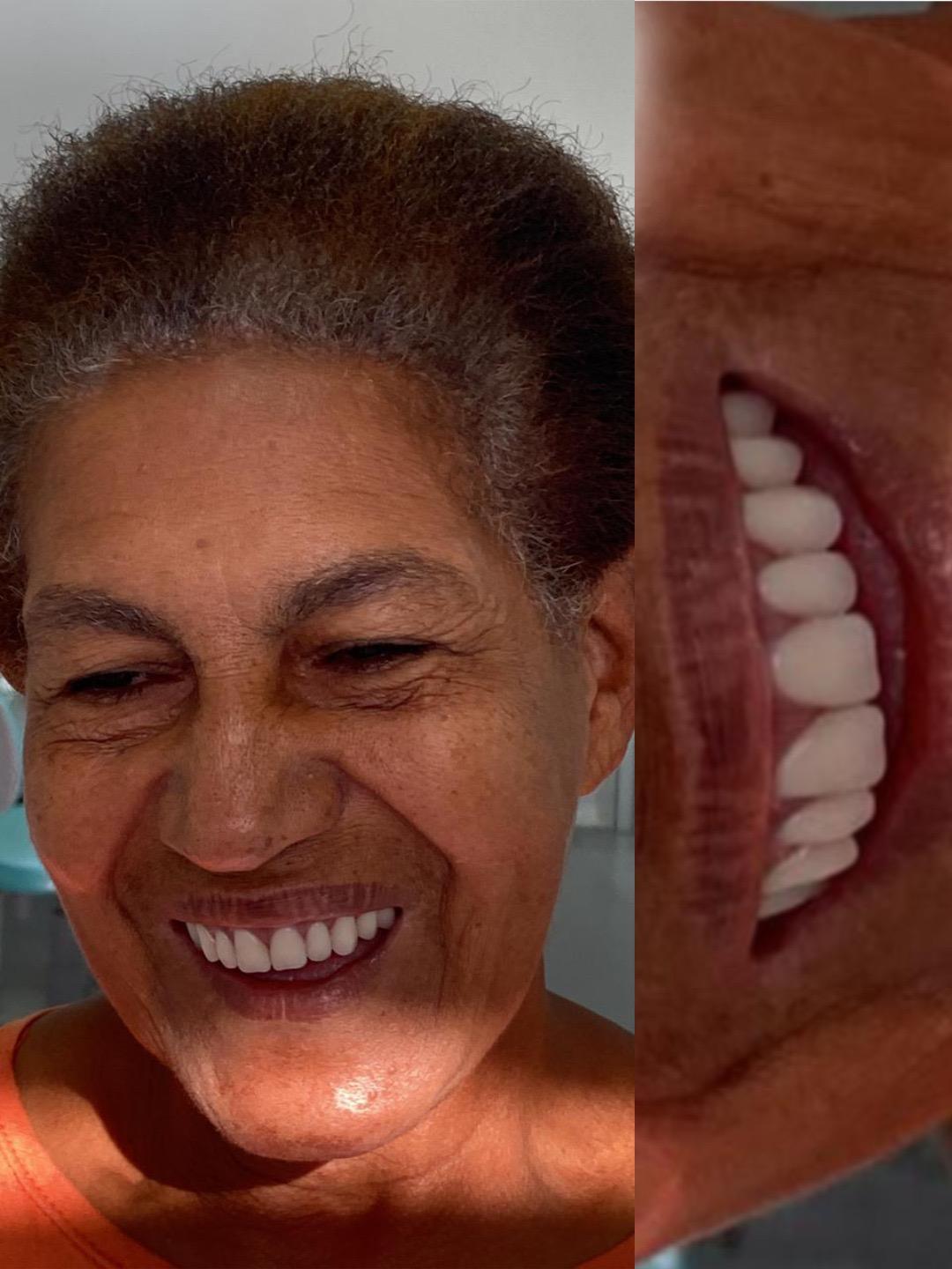 Antes e depois — Laminados de porcelana